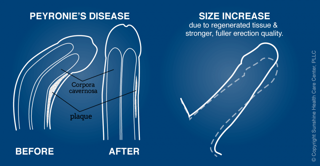 Chart showing benefits to Peyronies disease sufferers as well as potential ...