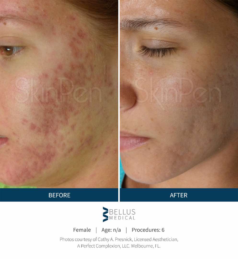 SkinPen® before and after 5