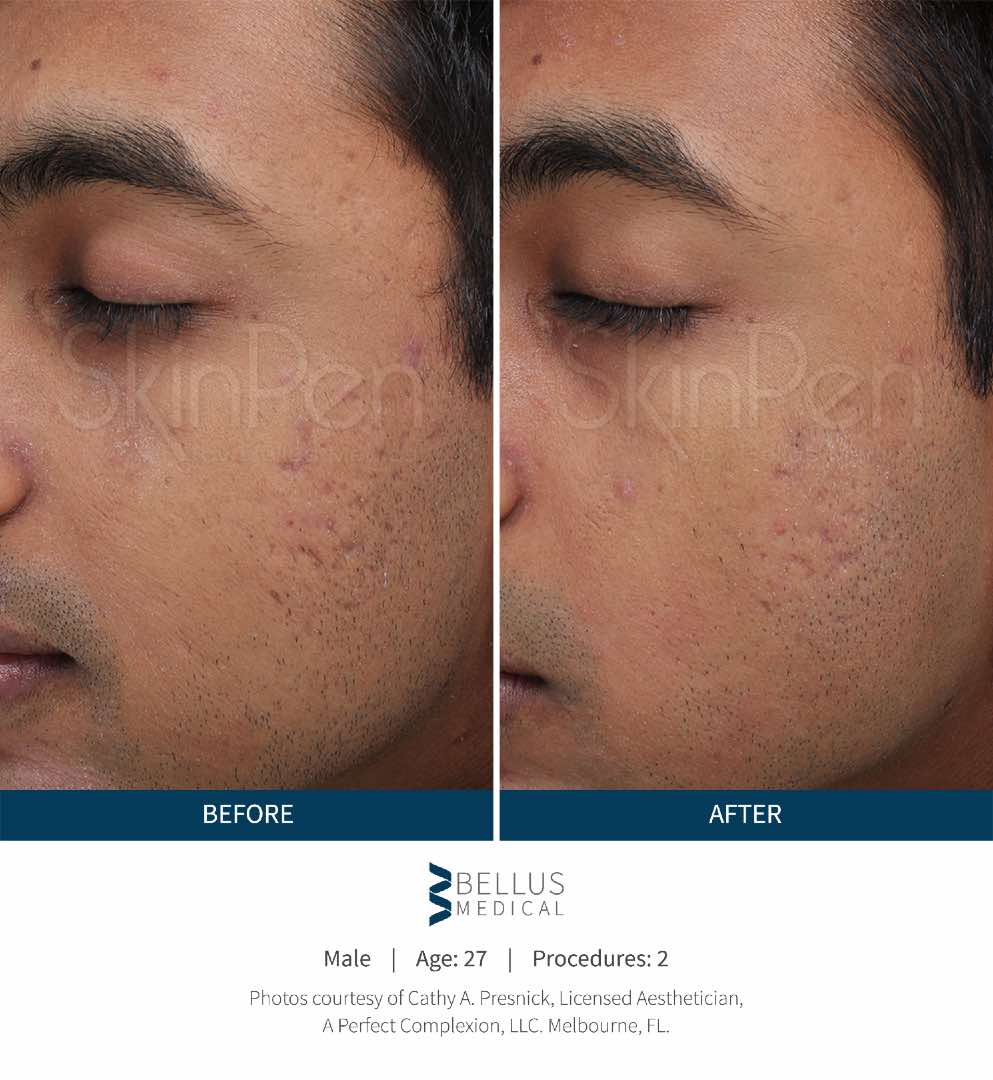 SkinPen® before and after 4