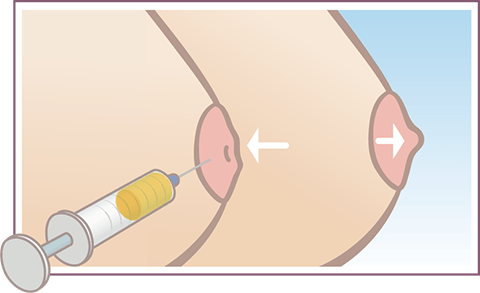 Graphic showing possible results from PRP nipple inversion procedure