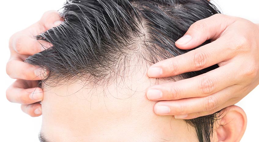 photo showing possible benefits of PRP hair restoration