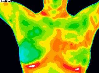 Example of a digital thermal scan showing abnormal heat signatures in early breast cancer victim